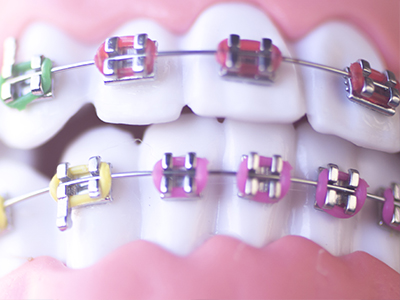 Straight Smiles Orthodontics | Teeth Whitening, Two-Phase Orthodontic Treatment and Adult Orthodontics
